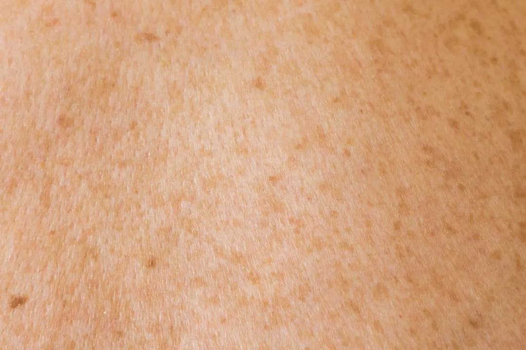 검은 점 붉은 점 다양한 점 피부 클로즈업 이미지